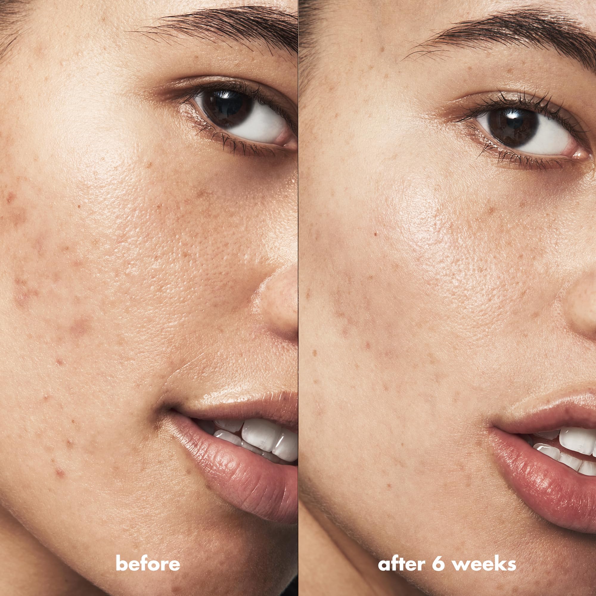 e.l.f. SKIN Blemish Breakthrough Spot Gel